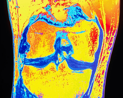 Image: Colored magnetic resonance imaging (MRI) scan of the knee joint showing meniscus degeneration (Photo courtesy of Simon Fraser / SPL).